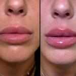 NPS_lip-filler-before-after-4.25