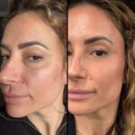nps_Before-after-laser-resurfacing-4.25
