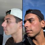 nps_before-after-laser-resurfacing-4.25-1