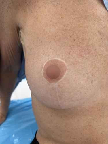 nps_breast-lift-scar