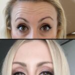 injectables-before-after