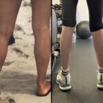 nps_injectables-calfs-before-after