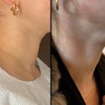 nps_laser-skin-resurfacing-4.25-3