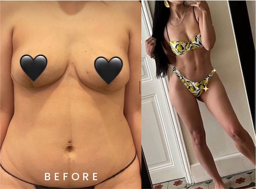 Differences-Between-Male-and-Female-Tummy-Tucks-B-C