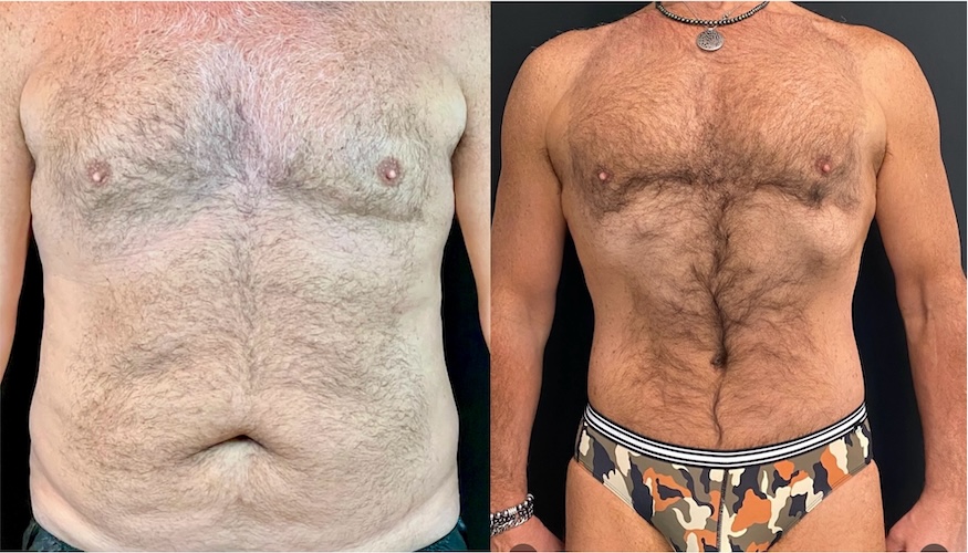 Differences-Between-Male-and-Female-Tummy-Tucks-D-E