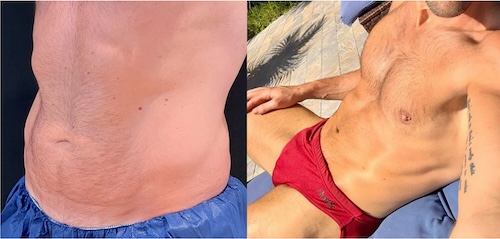 Differences-Between-Male-and-Female-Tummy-Tucks-G-H