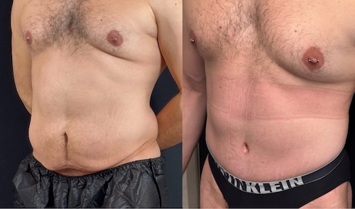 Differences-Between-Male-and-Female-Tummy-Tucks-I-J