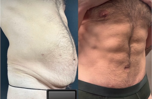 Differences-Between-Male-and-Female-Tummy-Tucks-K-L