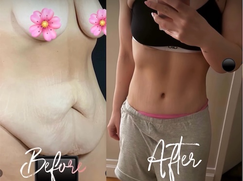 Differences-Between-Male-and-Female-Tummy-Tucks-M-N