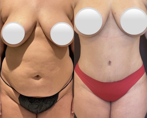 Differences-Between-Male-and-Female-Tummy-Tucks-F