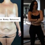 NPS_ozempic-plastic-surgery