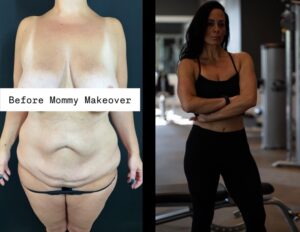 NPS_ozempic-plastic-surgery