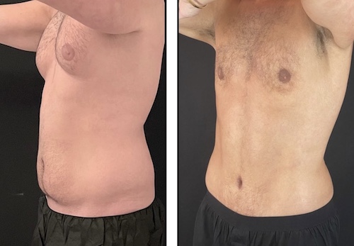 nps_funderburk-gynecomastia-2