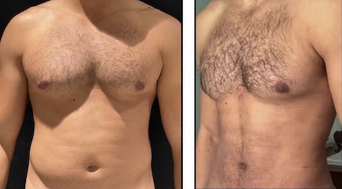 nps_funderburk-gynecomastia-4
