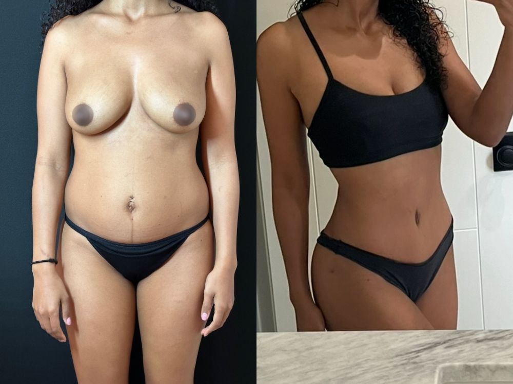 NPS_tummy-tuck-case-2.2-