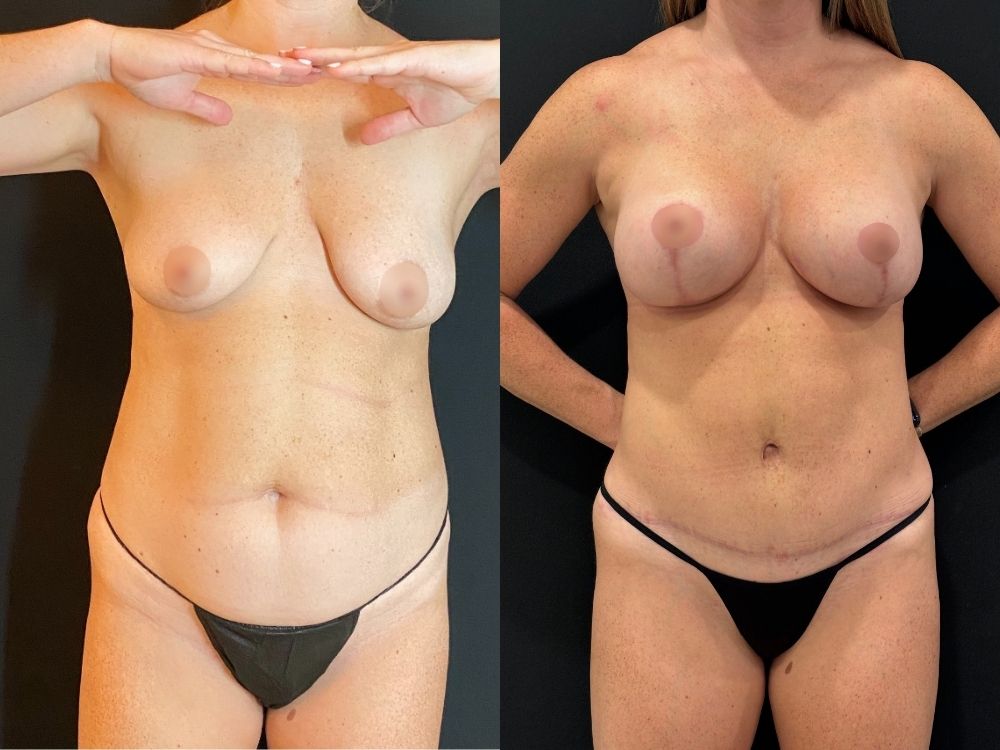 NPS_tummy-tuck-case-5.2pg