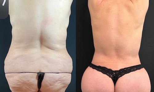 nps_before-after-mommy-makeover-9.23